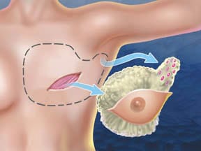 Breast Oncology
